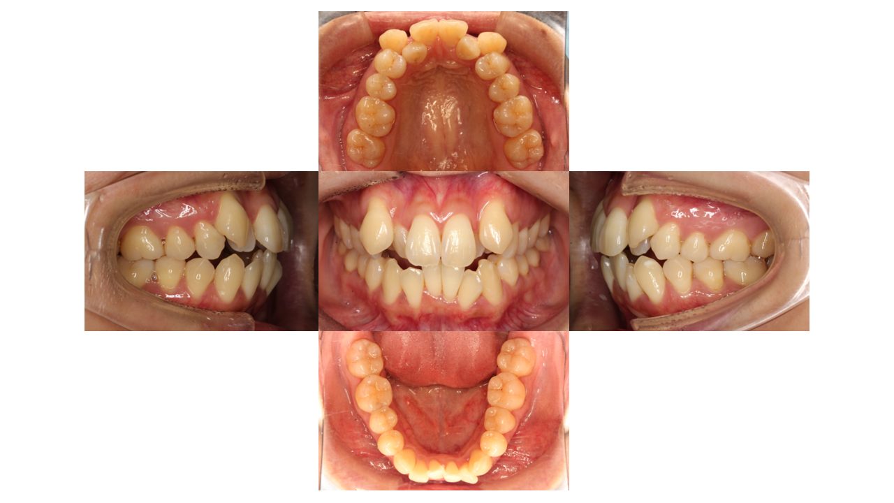 上下前歯凸凹　噛み合わせが悪い　ハーフリンガル矯正
