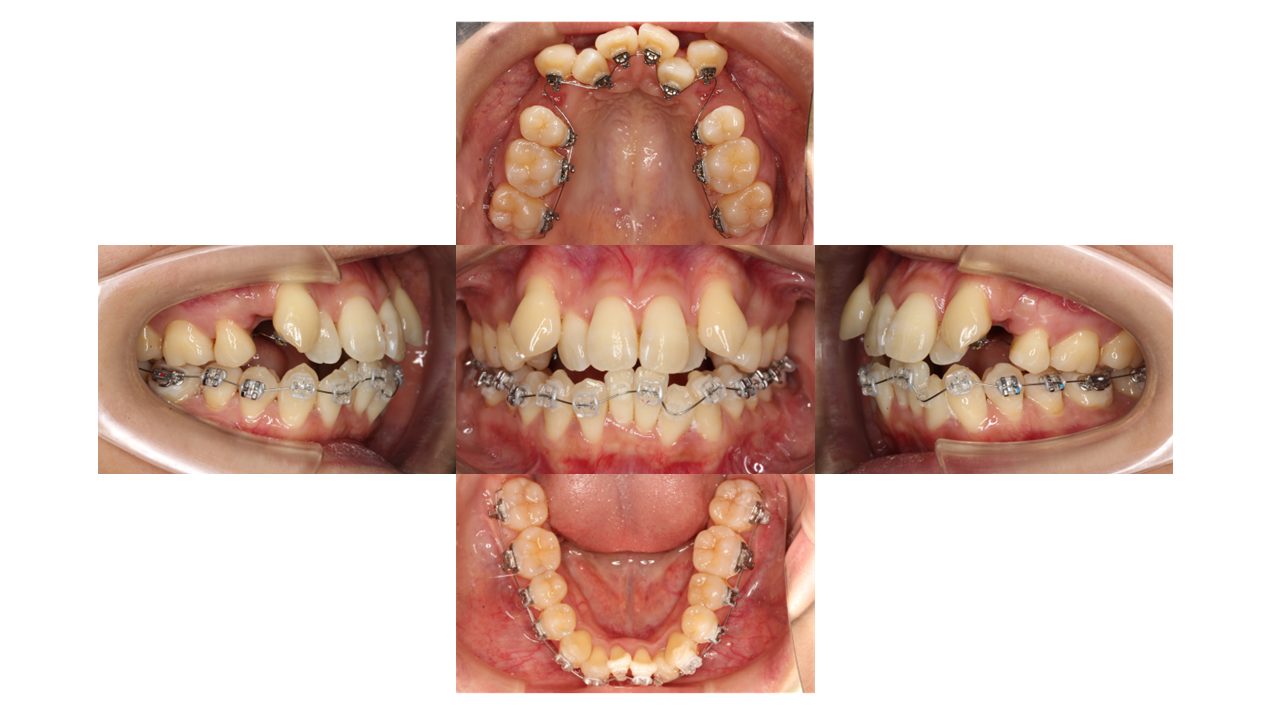 上下前歯凸凹　噛み合わせが悪い　ハーフリンガル矯正