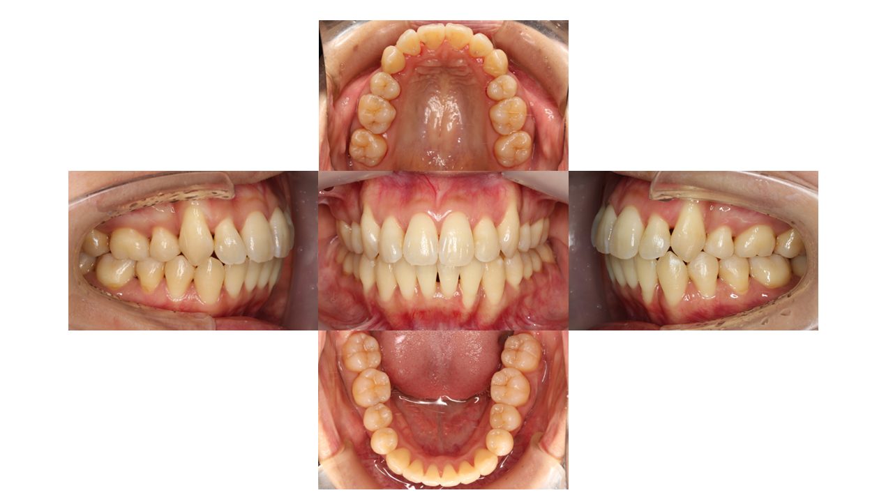 上下前歯凸凹　噛み合わせが悪い　ハーフリンガル矯正