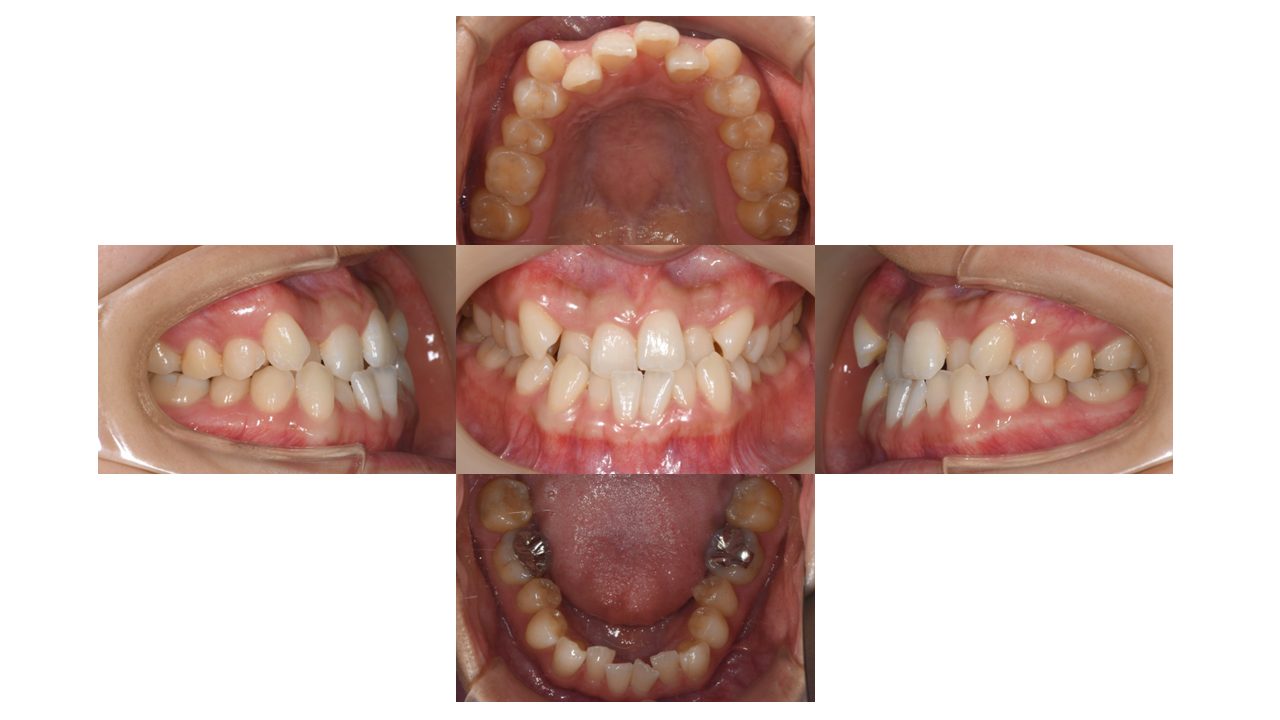 上下の凸凹　噛み合わせが悪い　マウスピース矯正　インビザライン