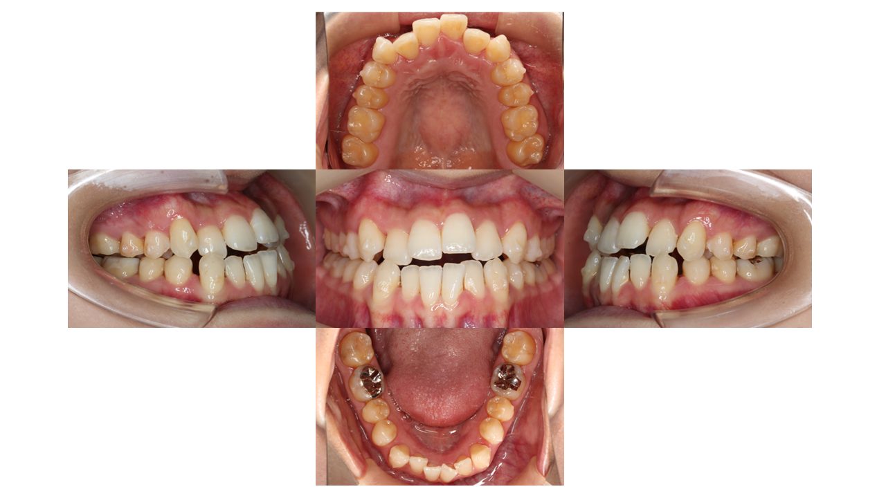 上下の凸凹　噛み合わせが悪い　マウスピース矯正　インビザライン