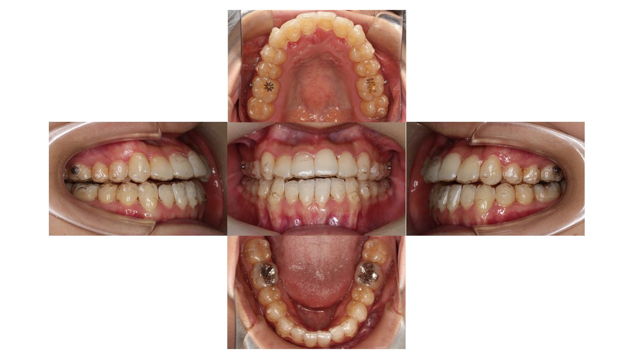 上下の凸凹　噛み合わせが悪い　マウスピース矯正　インビザライン