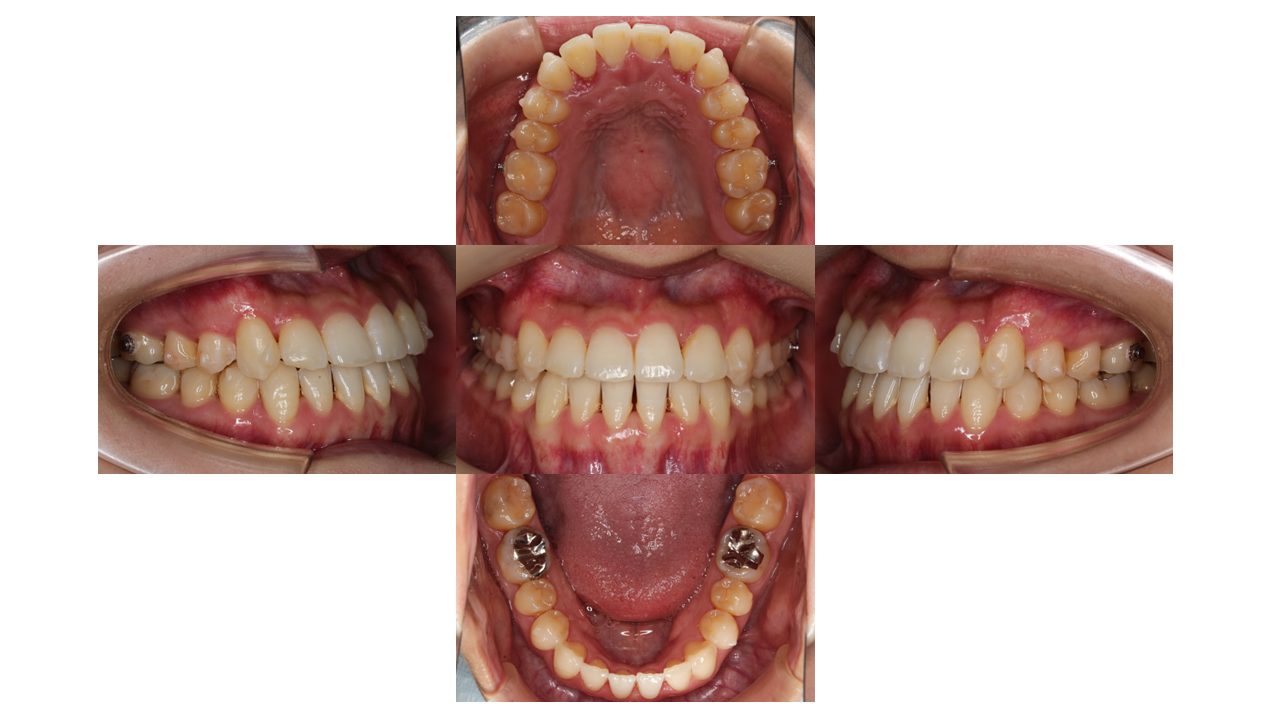 上下の凸凹　噛み合わせが悪い　マウスピース矯正　インビザライン