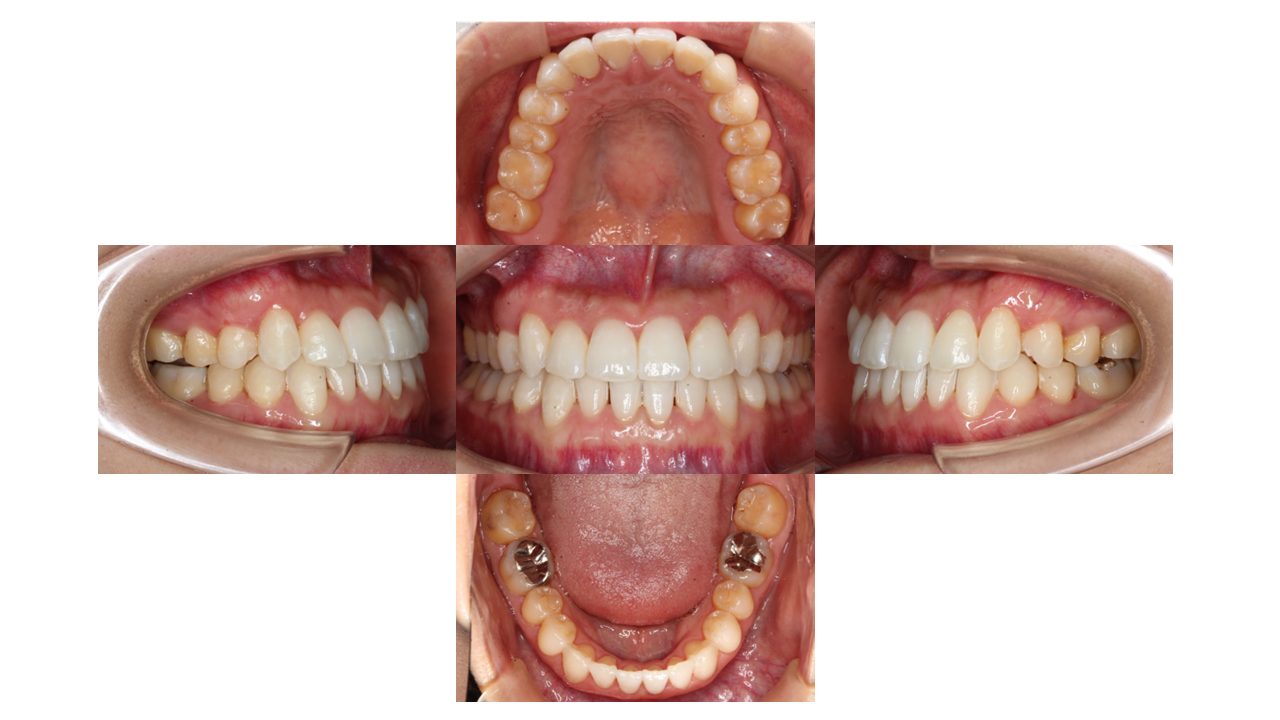 上下の凸凹　噛み合わせが悪い　マウスピース矯正　インビザライン