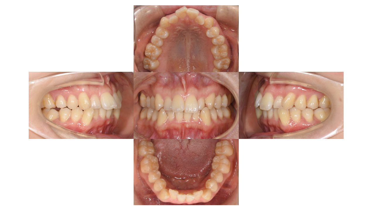 上下前歯の凸凹　マウスピース矯正　インビザライン