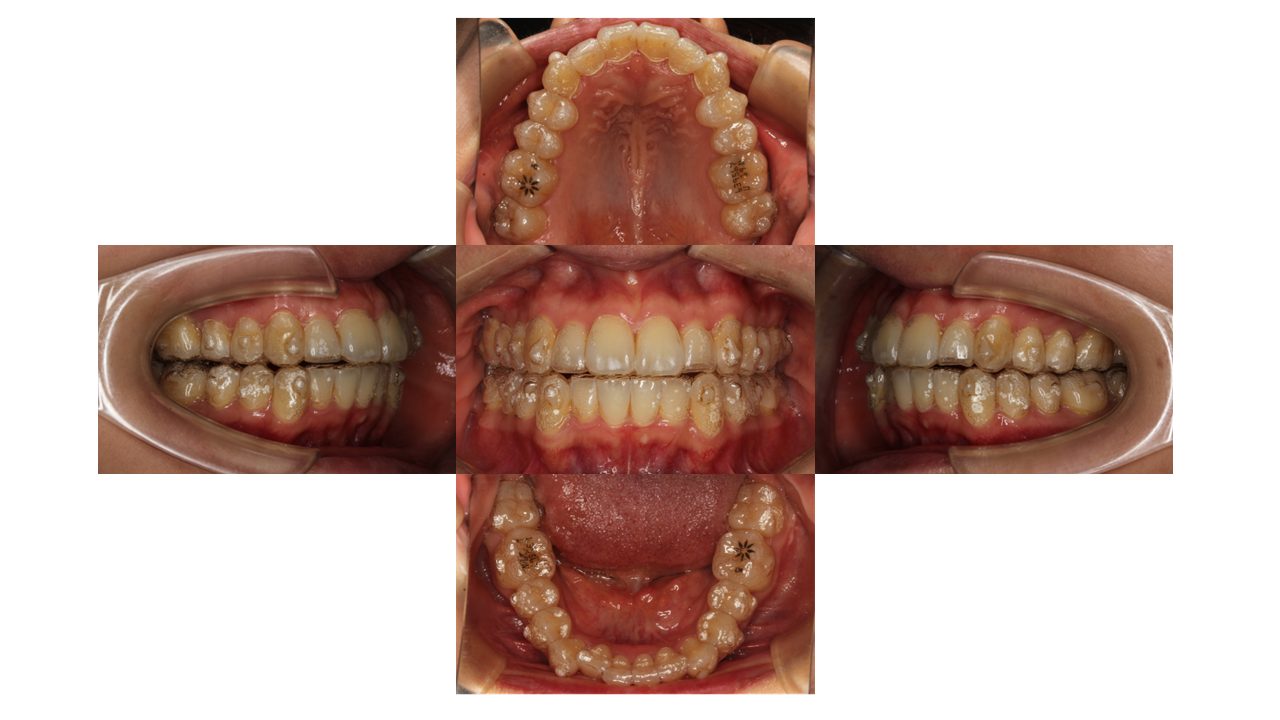 上下前歯の凸凹　マウスピース矯正　インビザライン