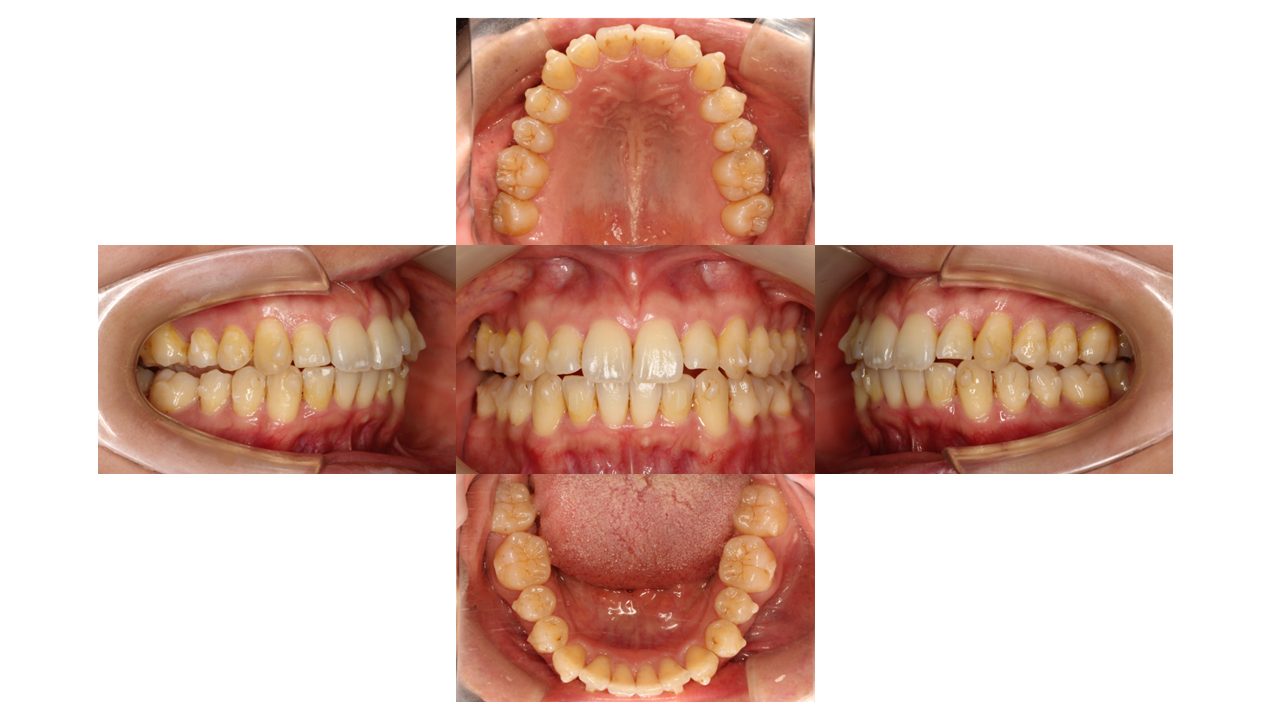 上下前歯の凸凹　マウスピース矯正　インビザライン