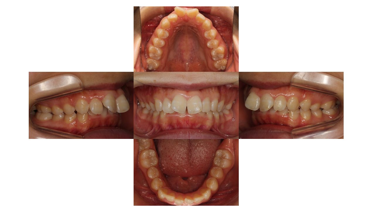 上顎前歯の凸凹　ハーフリンガル