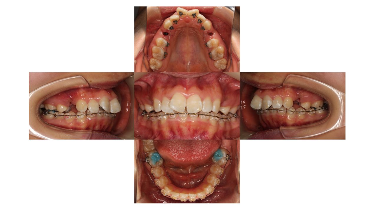 上顎前歯の凸凹　ハーフリンガル