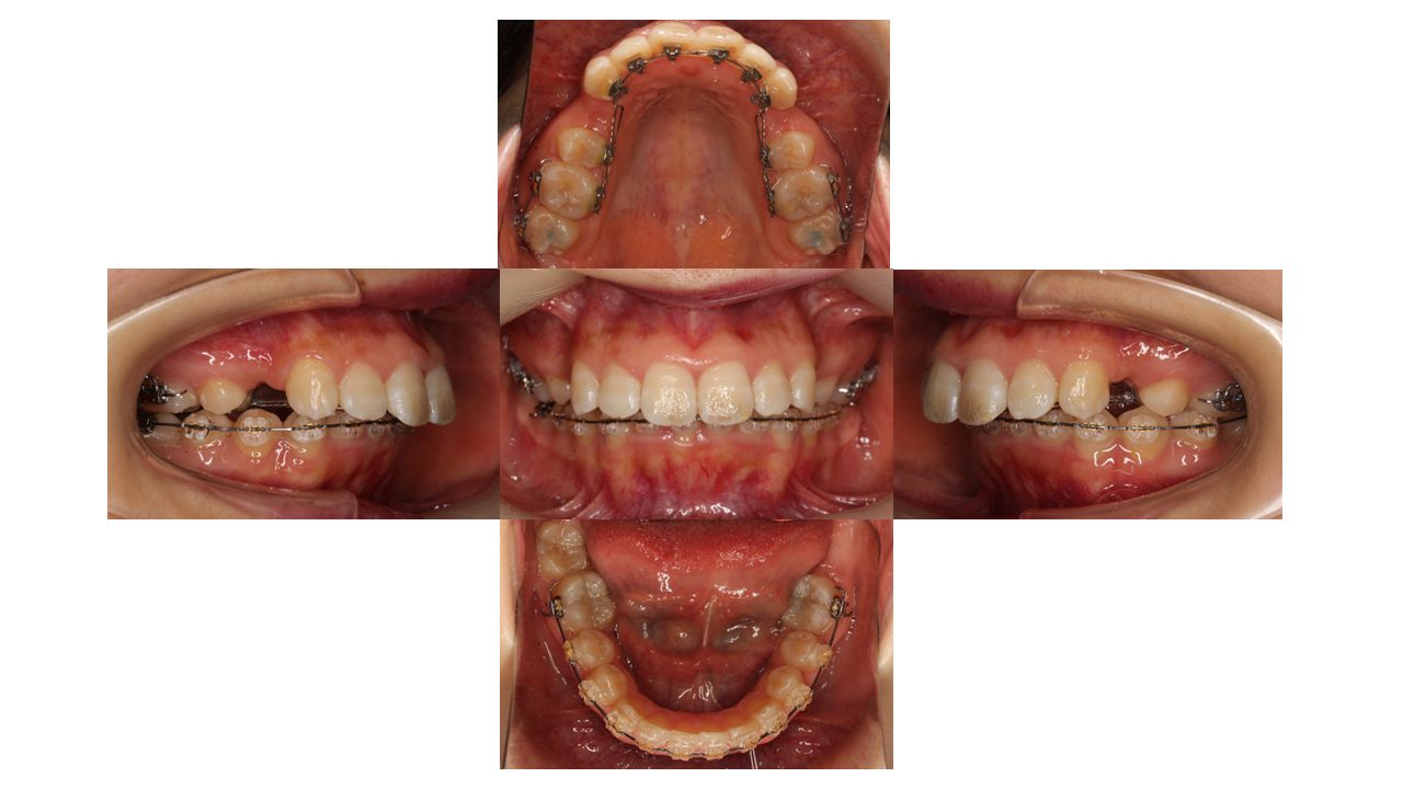 上顎前歯の凸凹　ハーフリンガル
