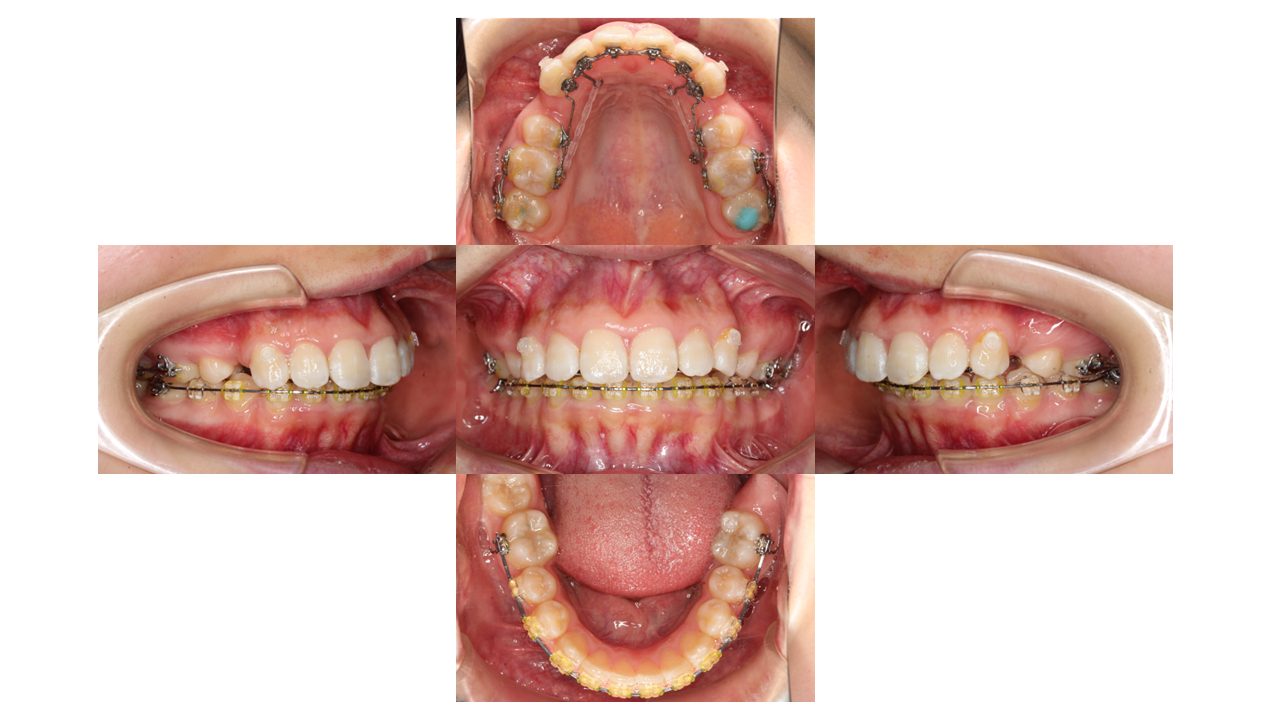 上顎前歯の凸凹　ハーフリンガル