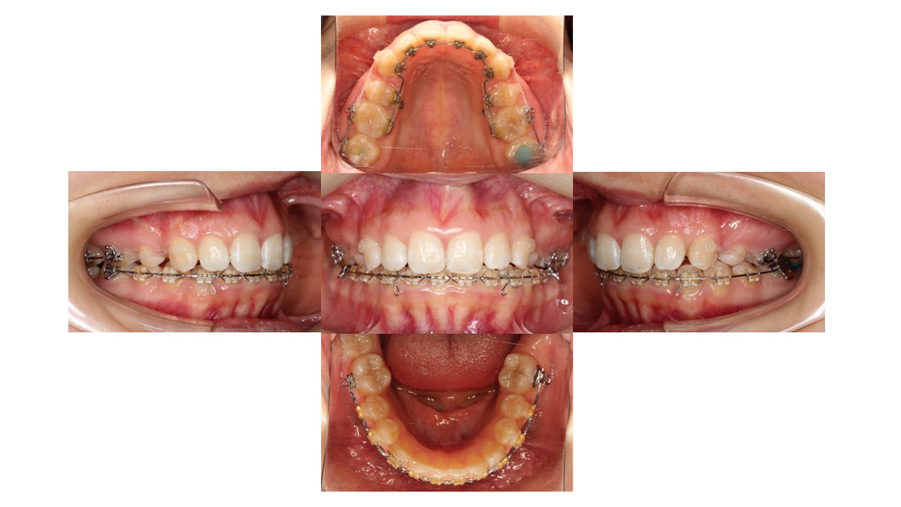上顎前歯の凸凹　ハーフリンガル