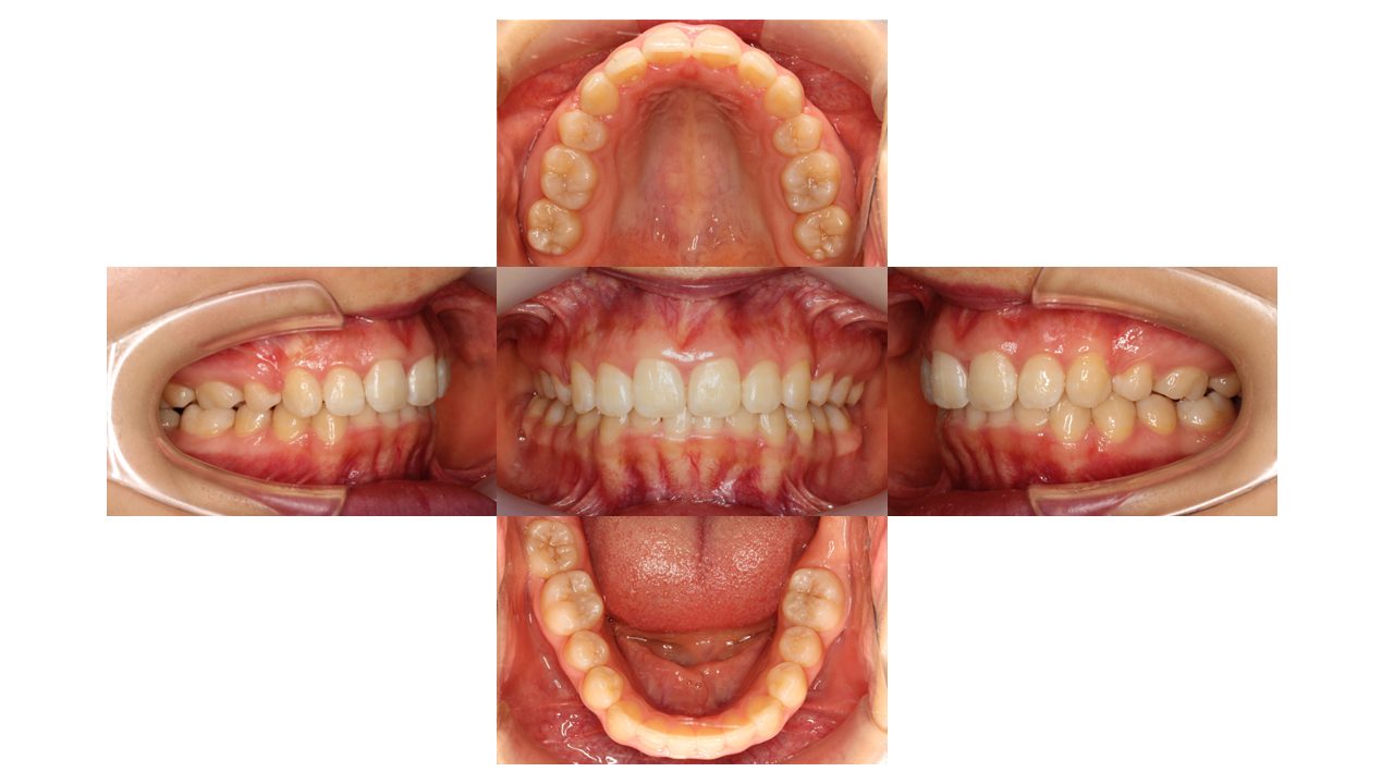 上顎前歯の凸凹　ハーフリンガル