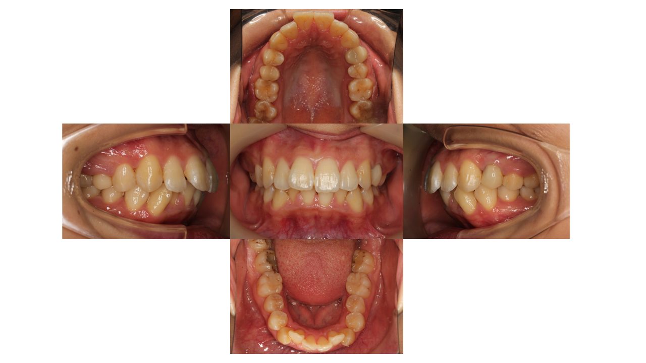 口元を下げたい リンガル矯正