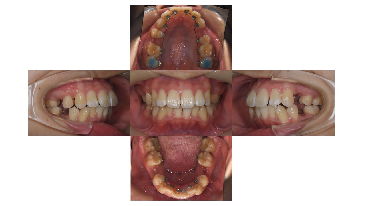 口元を下げたい リンガル矯正