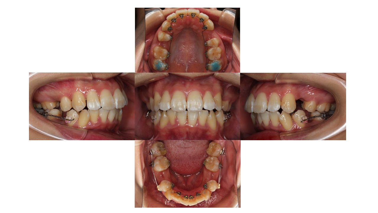 口元を下げたい リンガル矯正