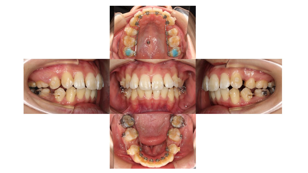 口元を下げたい リンガル矯正