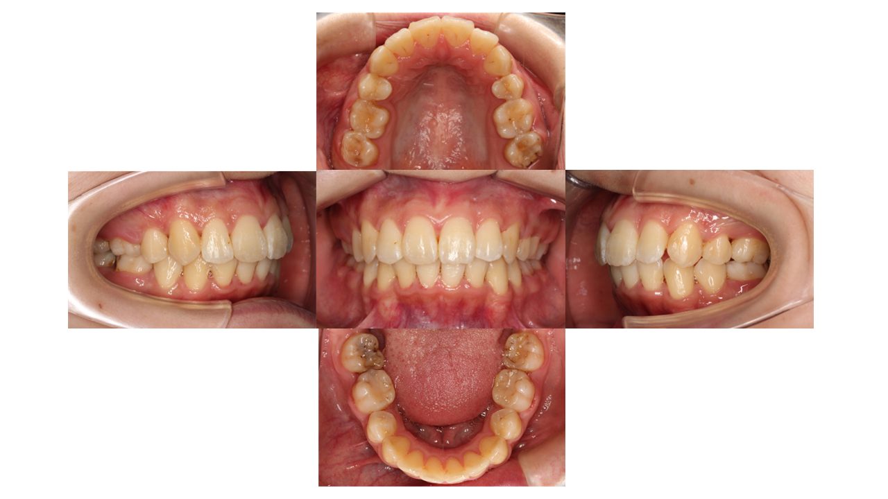 口元を下げたい リンガル矯正