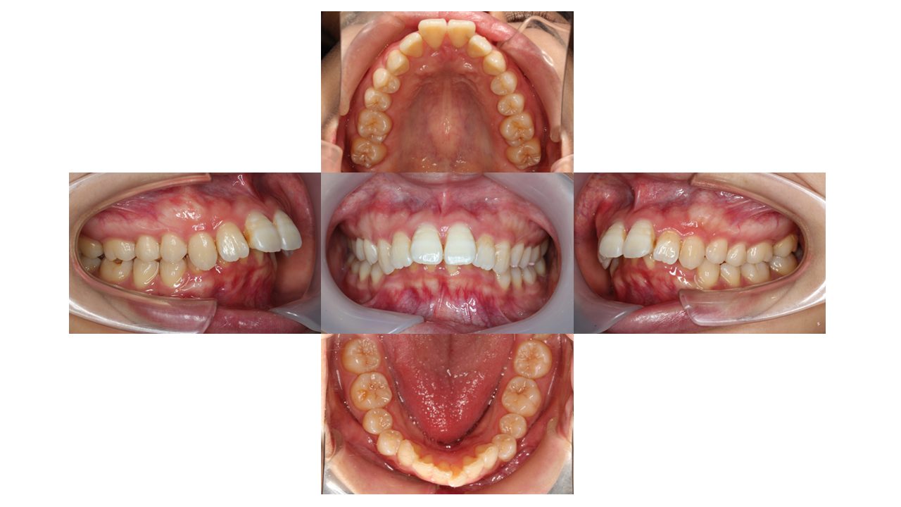 上の前歯が出ている 口元を下げたい