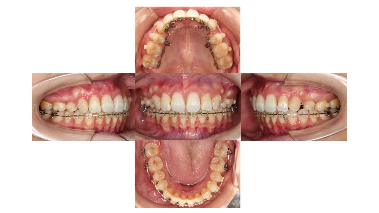 上の前歯が出ている 口元を下げたい