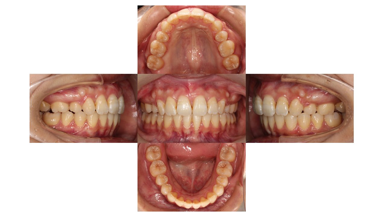 上の前歯が出ている 口元を下げたい