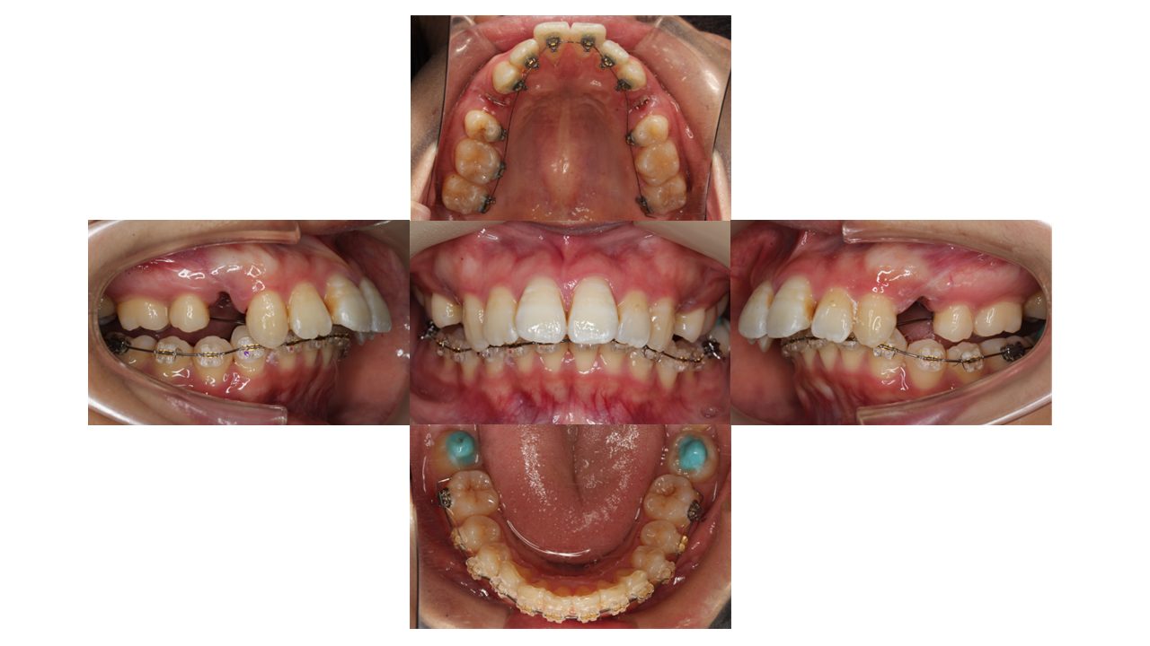 上の前歯が出ている 口元を下げたい