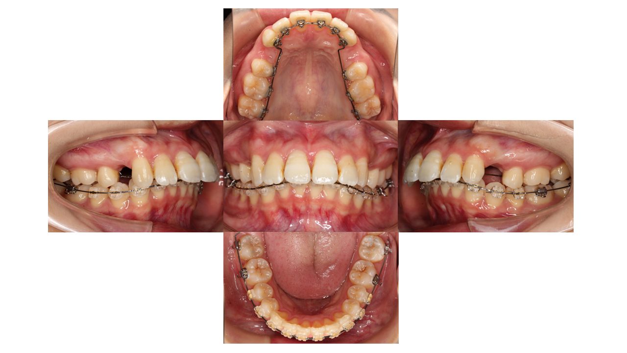 上の前歯が出ている 口元を下げたい