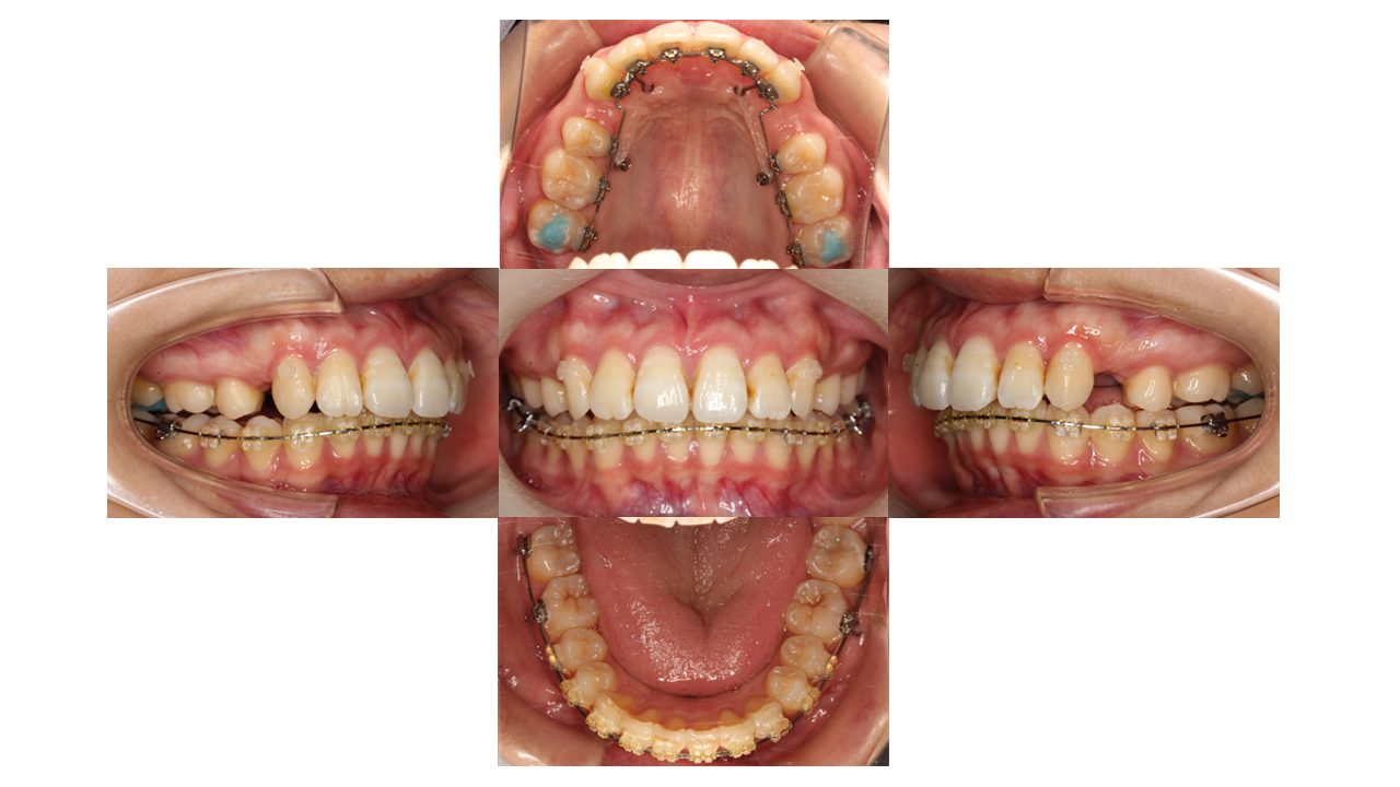 上の前歯が出ている　口元を下げたい