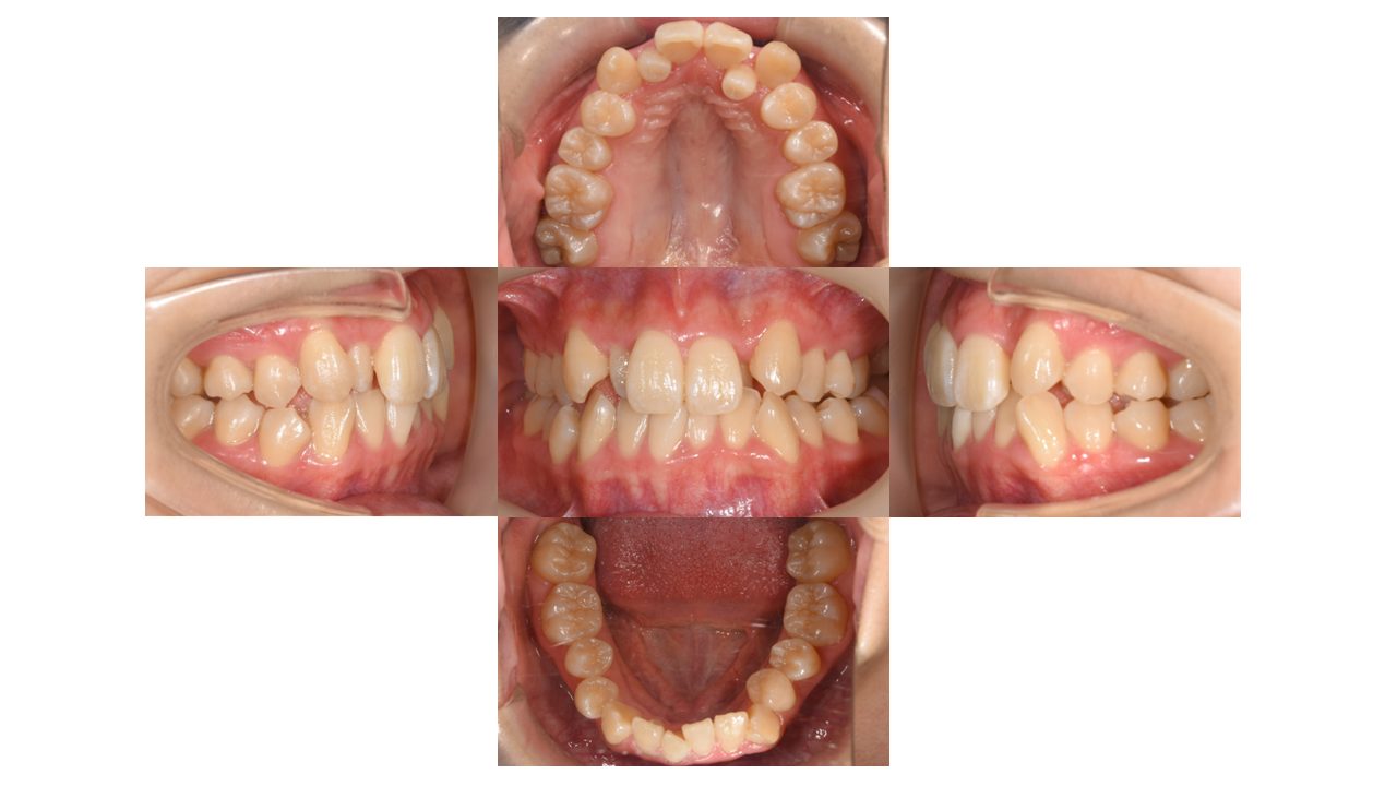 上下前歯の凸凹　マウスピース矯正　インビザライン