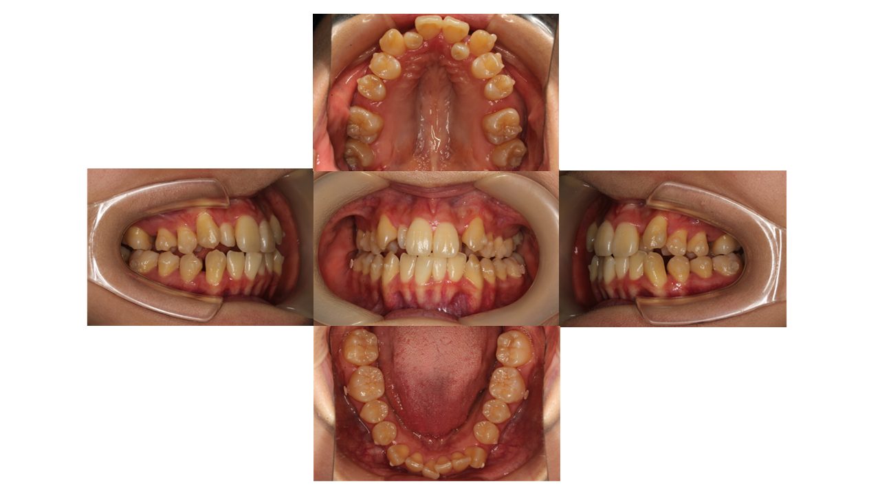 上下前歯の凸凹　マウスピース矯正　インビザライン