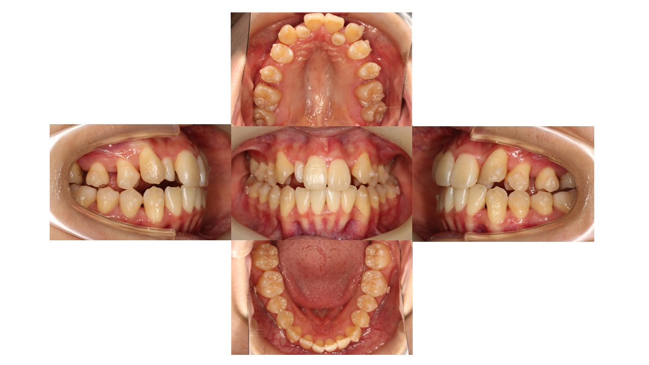 上下前歯の凸凹　マウスピース矯正　インビザライン