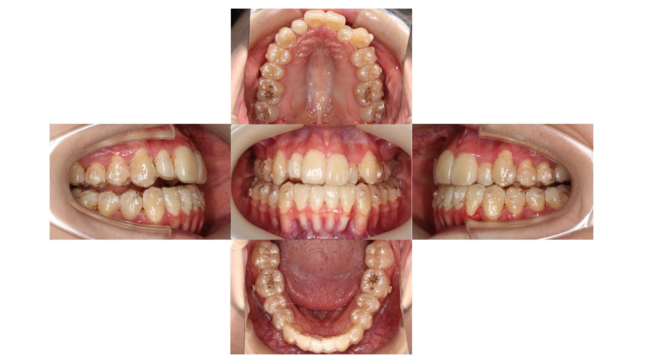 上下前歯の凸凹　マウスピース矯正　インビザライン