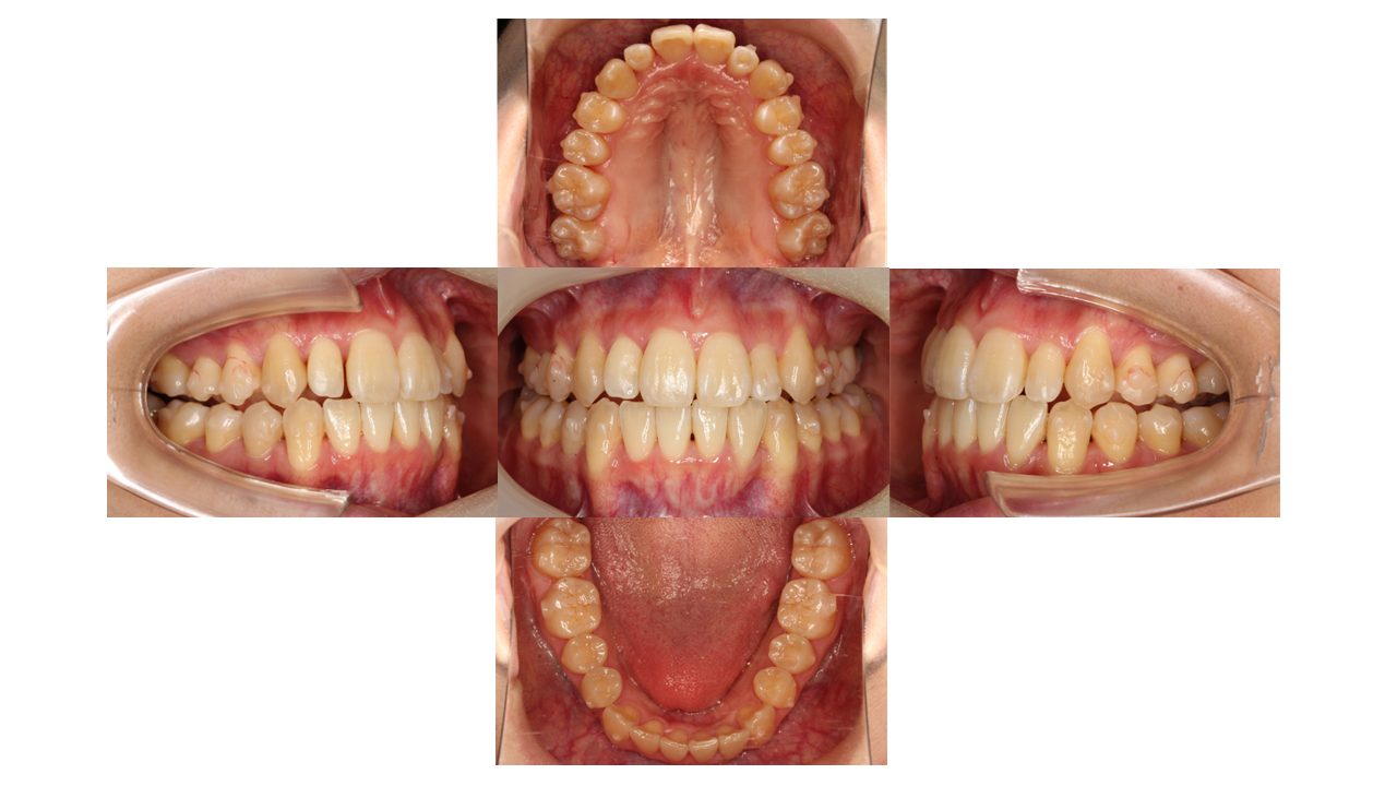 上下前歯の凸凹　マウスピース矯正　インビザライン