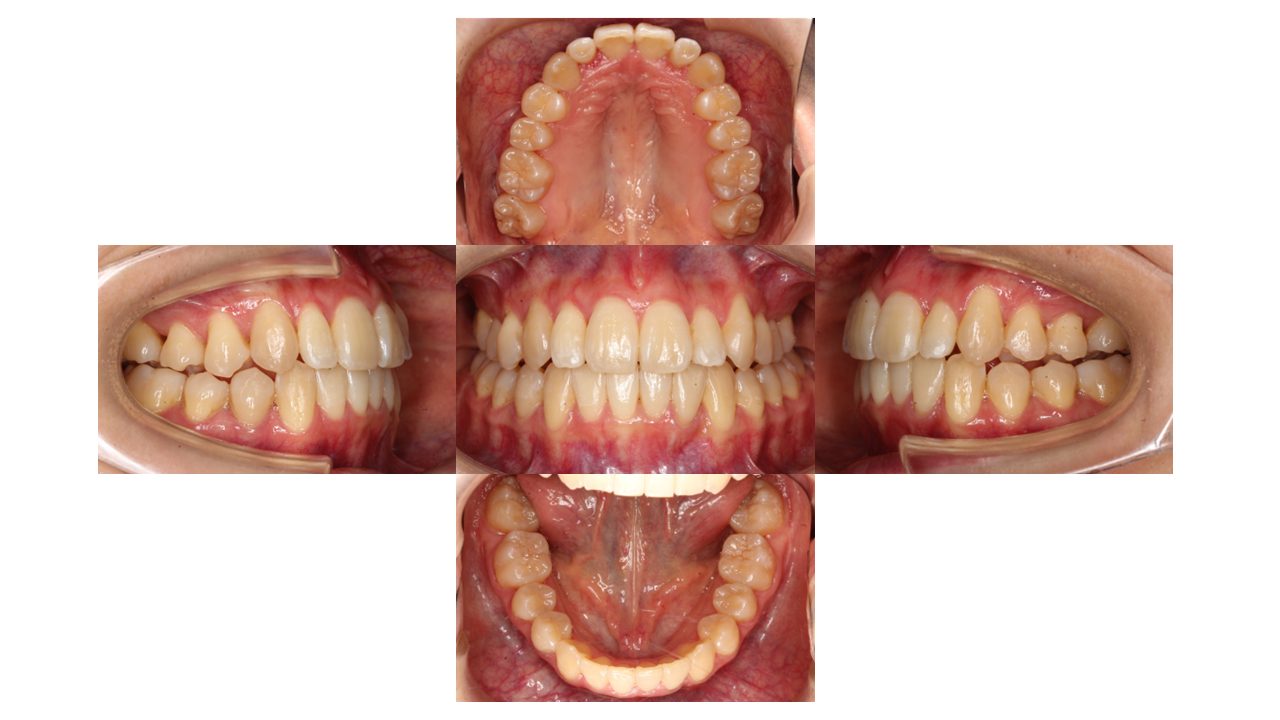 上下前歯の凸凹　マウスピース矯正　インビザライン