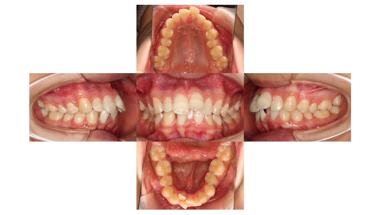 上下前歯の凸凹　出っ歯　裏側矯正