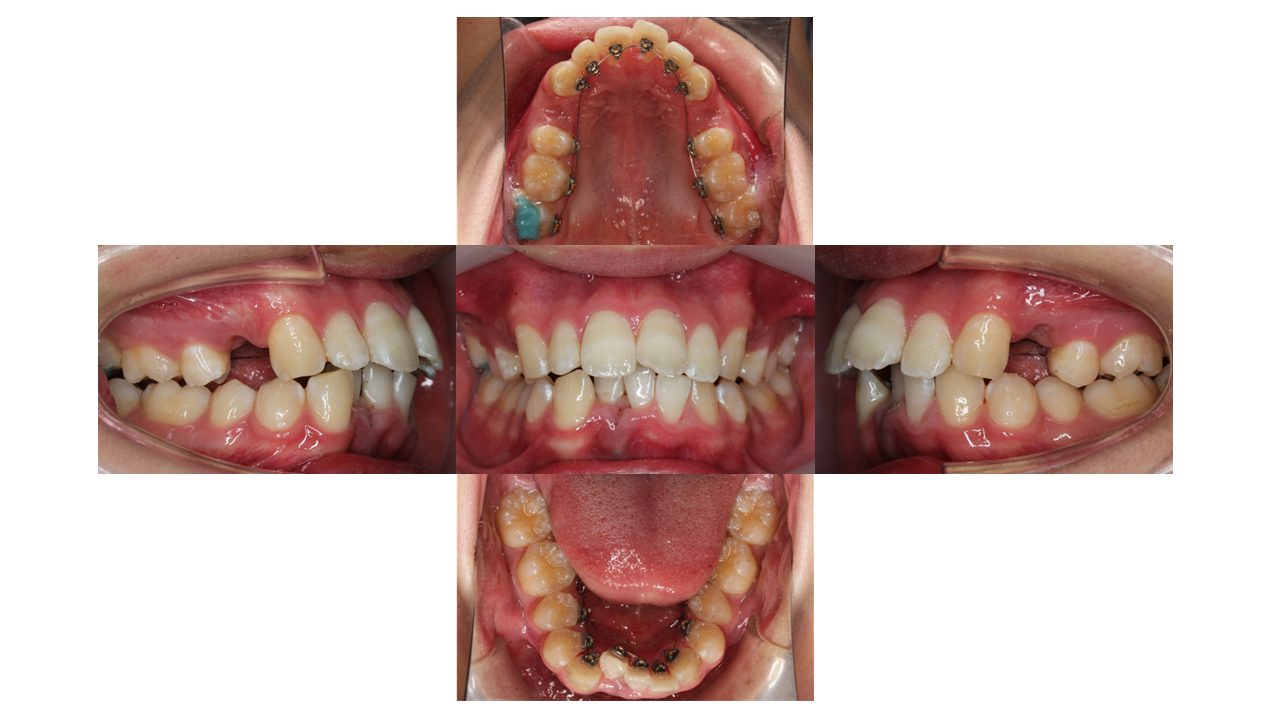 上下前歯の凸凹　出っ歯　裏側矯正