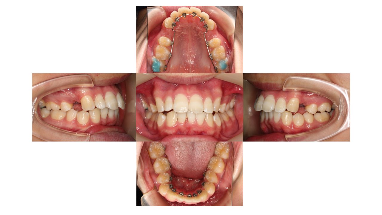 上下前歯の凸凹　出っ歯　裏側矯正