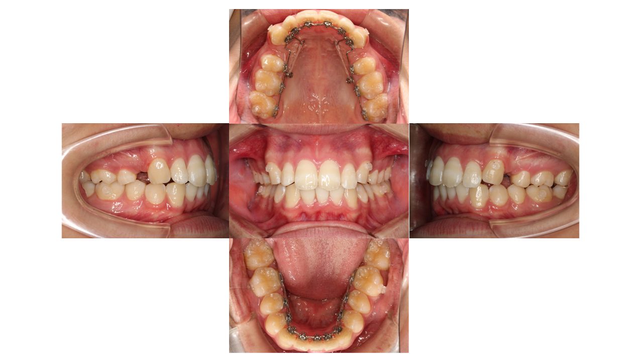 上下前歯の凸凹　出っ歯　裏側矯正