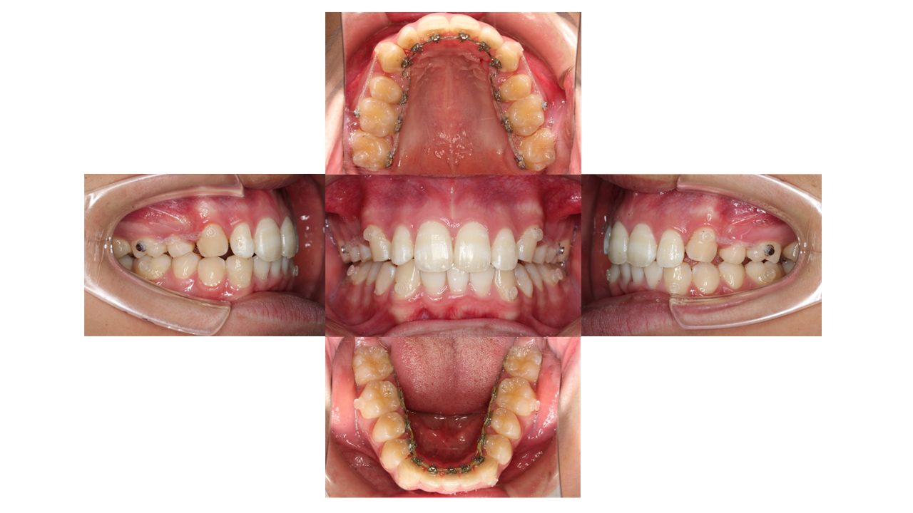 上下前歯の凸凹　出っ歯　裏側矯正