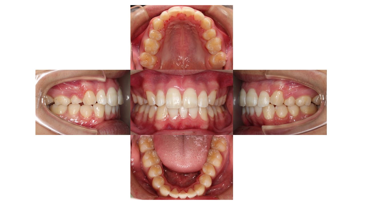 上下前歯の凸凹　出っ歯　裏側矯正