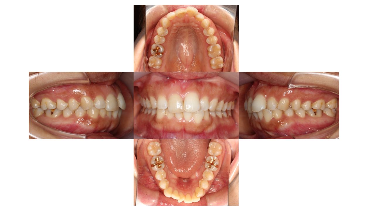 上下の凸凹 口元下げたい リンガル矯正 マウスピース矯正