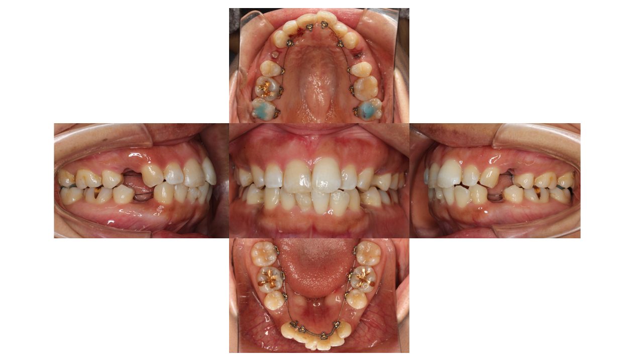 上下の凸凹 口元下げたい リンガル矯正 マウスピース矯正