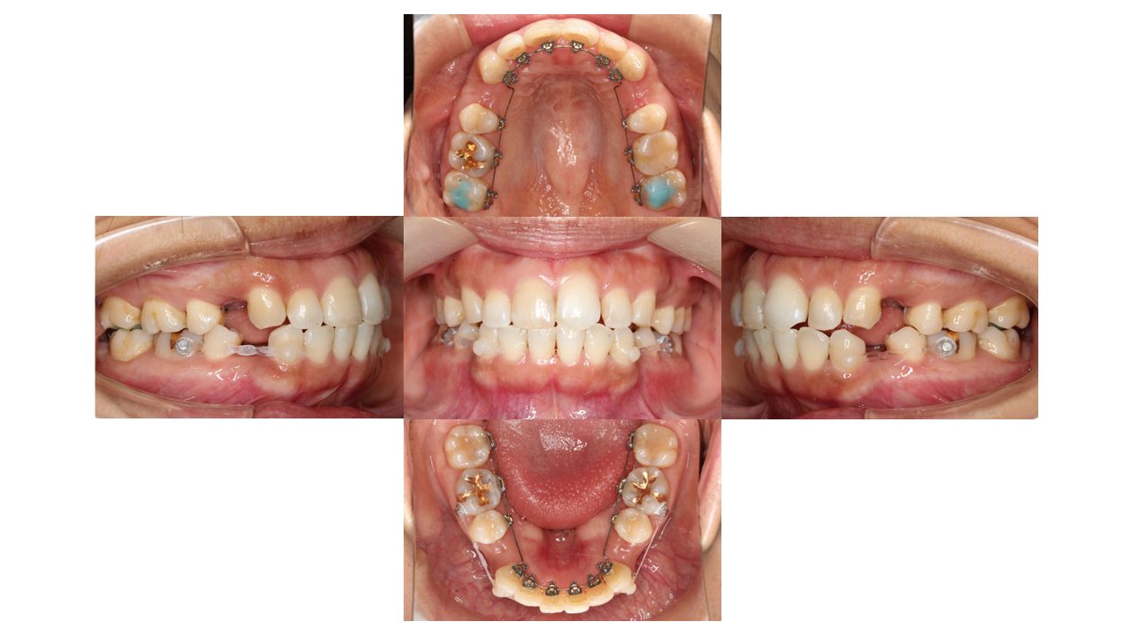 上下の凸凹 口元下げたい リンガル矯正 マウスピース矯正