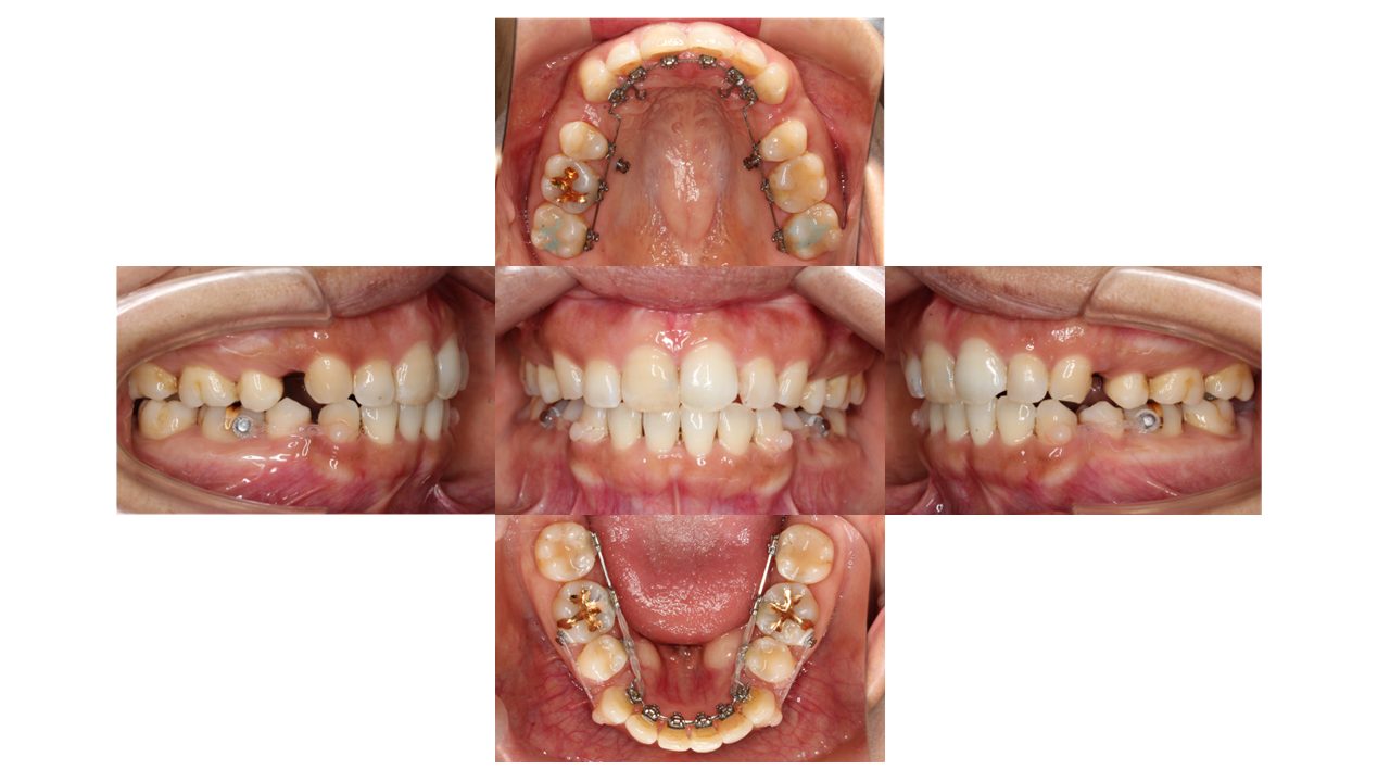上下の凸凹 口元下げたい リンガル矯正 マウスピース矯正