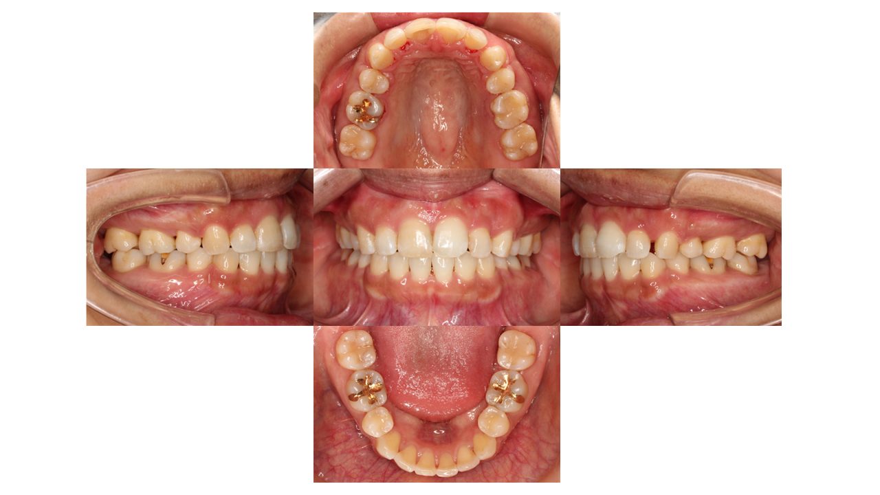 上下の凸凹 口元下げたい リンガル矯正 マウスピース矯正