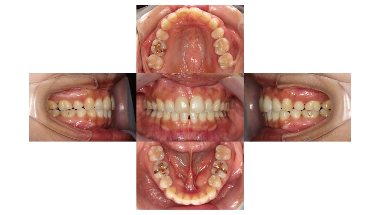 上下の凸凹 口元下げたい リンガル矯正 マウスピース矯正