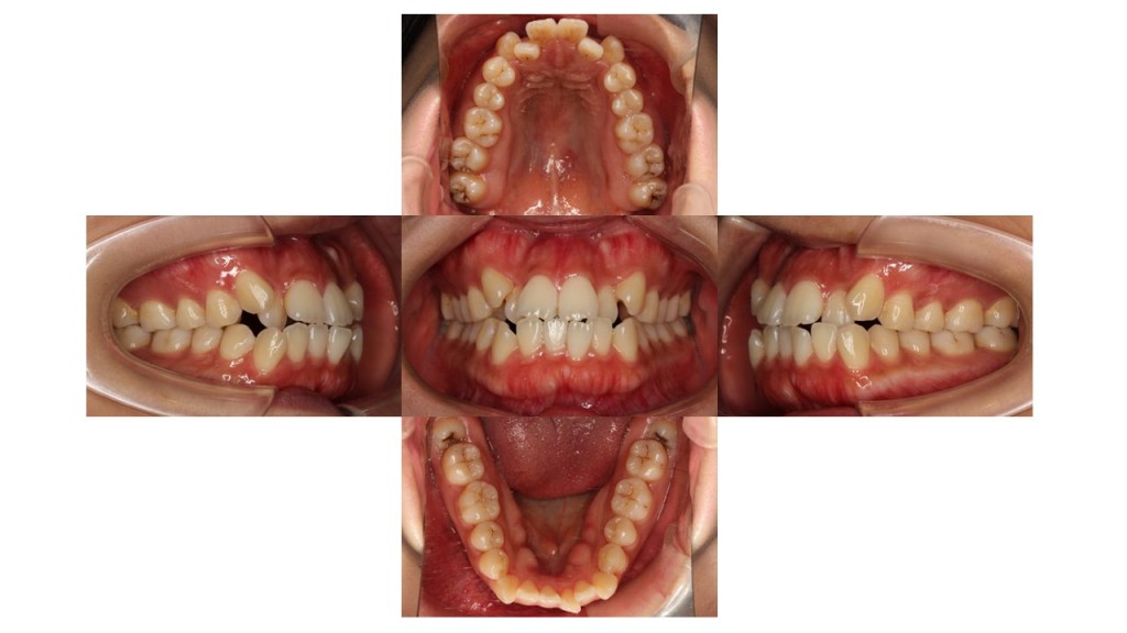 八重歯　前歯の凸凹　インビザライン　マウスピース矯正