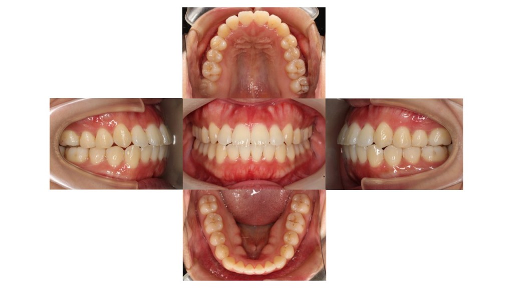 八重歯　前歯の凸凹　インビザライン　マウスピース矯正