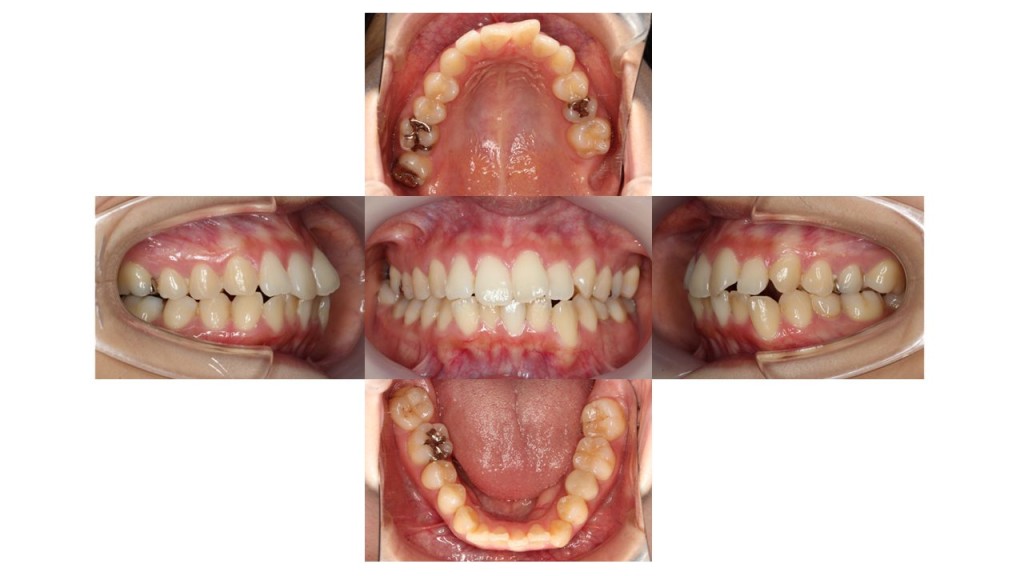 上顎前歯の突出 凸凹 インビザライン マウスピース矯正