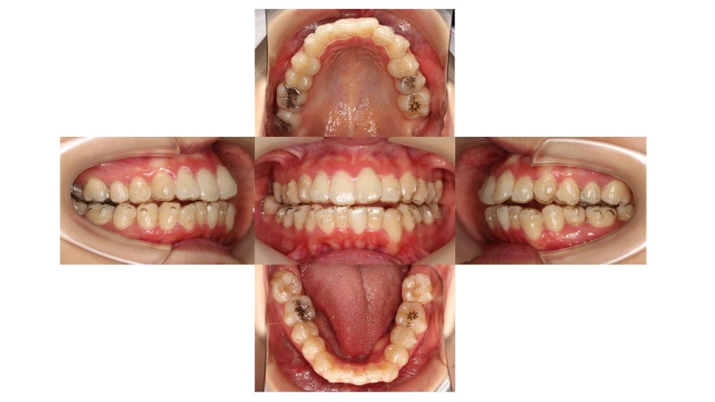 上顎前歯の突出 凸凹 インビザライン マウスピース矯正